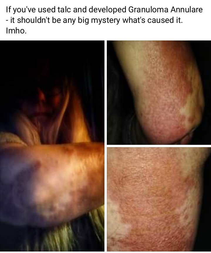 TalcTruth's tweet image. Granuloma Annulare from Talc? READ: m.facebook.com/story.php?stor… 
@RealDonaldTrump @VP @FDACommissioner @US_FDA @CPSCCommissioner @SteveHahnMD change.org/p/rosemary-yuh… #talc #babypowder #talcumpowder #RealDonaldTrump #VP #FDACommissioner #US_FDA #CPSCCommissioner #SteveHahnMD #RadOnc