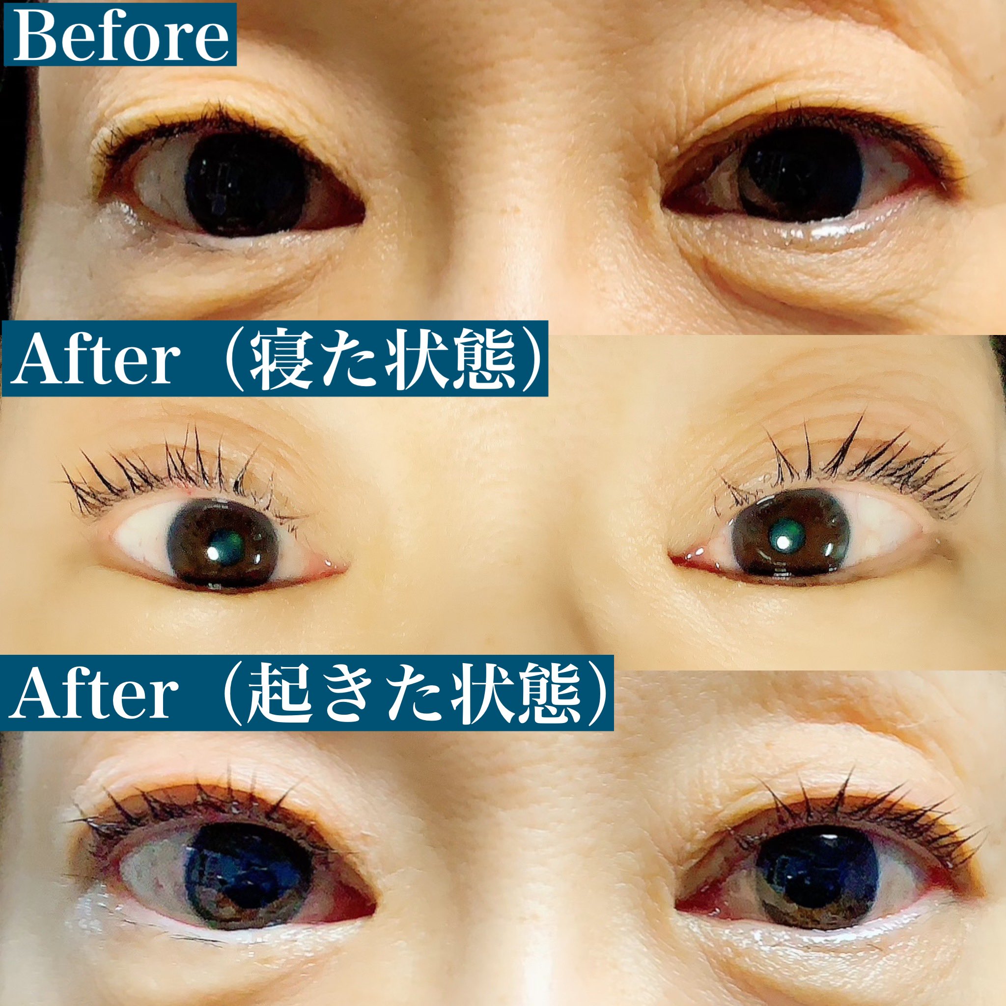 まつげのお店yocchi アイリッドアップパーマ アイリッドアップパーマ アイリッドダウンパーマ まぶた上げパーマ 逆まつげ まぶたが重い まぶたのたるみ 眼瞼下垂 アイリッドアップパーマ練習中 北海道 千歳 千歳市 千歳市マツエク マツエク