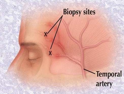 MdWarrington's tweet photo. Check out our study on #giantcellarteritis and its mimics: A comparison of 3 patient cohorts #vasculitis #mayoclinic #headache @VasculitisFound @vasculitides  https://t.co/82c860bBSm https://t.co/Q2bnRdOx9Q