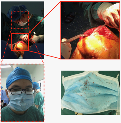 Surgical masks as source of bacterial contamination during operative procedures 2018The pictures who why surgeons wear masks. 18/ https://www.researchgate.net/publication/326039569_Surgical_masks_as_source_of_bacterial_contamination_during_operative_procedures