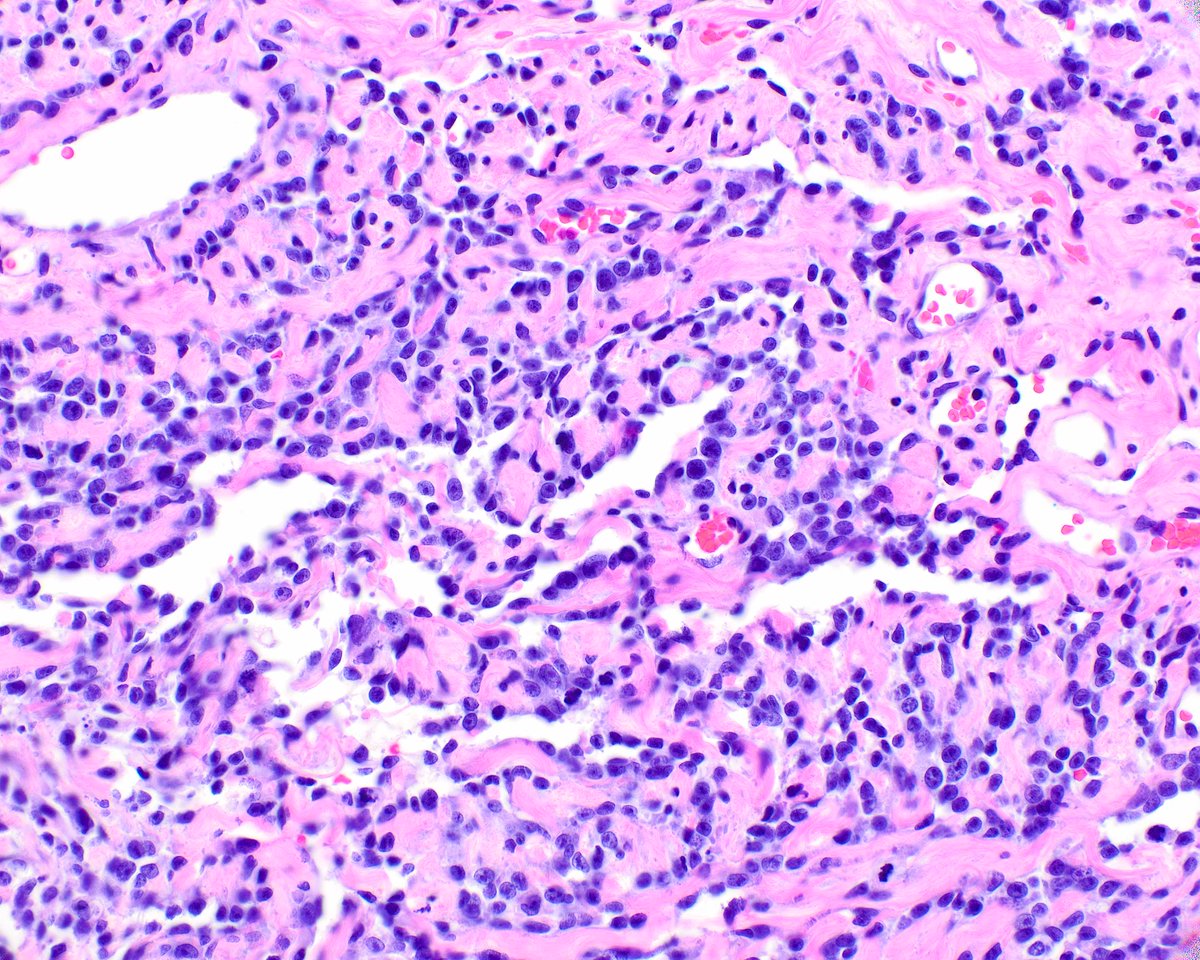 LizMontgomeryMD's tweet photo. Striking angiosarcoma, probably post-radiation.  The immunostain is CD31. https://t.co/HtWTmUf4GU