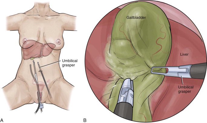 Natural Orifice Transluminal Endoscopic Cholecystectomy: how to do it! Do you think still is a valid option?  #SoMe4Surgery  #MedTwitter  @juliomayol  @SWexner  @anhanssen  @elliotthaut  @MISIRG1  @pferrada1  @DissanaikeMD  @almagoch