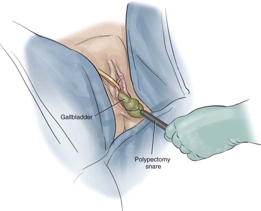  #SoMe4Surgery  #MedTwitter  @juliomayol  @SWexner  @anhanssen  @elliotthaut  @MISIRG1  @pferrada1  @DissanaikeMD  @almagoch