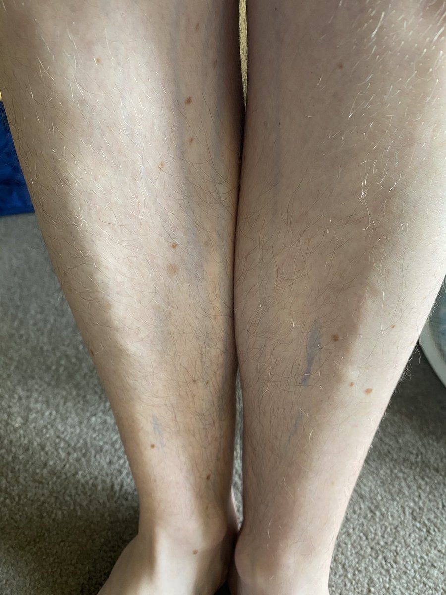 I have rivulets of blue running down my entire body from head to toe. Here are my legs. Streaked with blue.