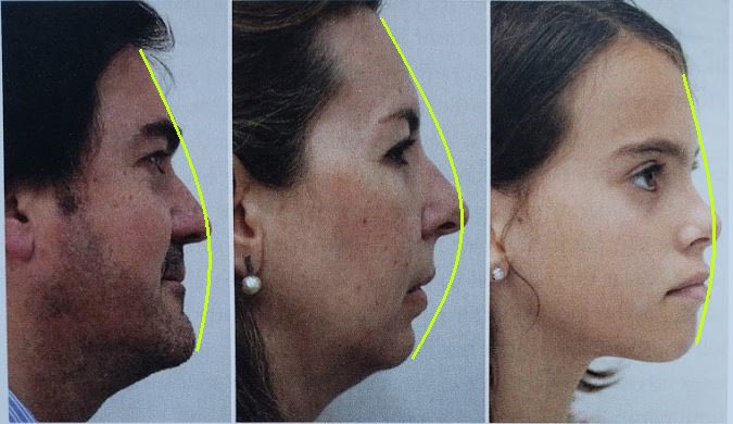 The jaws do not fully develop and are set back from their ideal position, thus reducing airway size. If the jaws are not positioned forward enough on the face, they will encroach on the airways (McKeown, 2015).If we sleep with our mouth open, this can also promote overbreathing