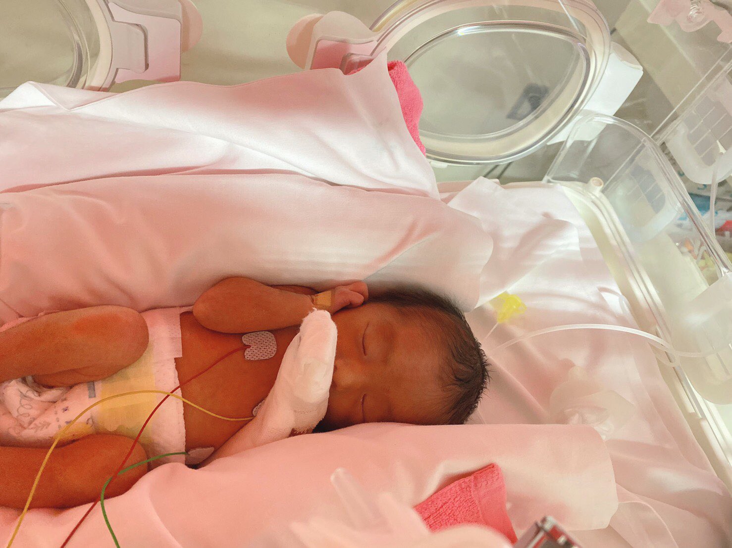 お嫁ちゃん 9 21 15 11と15 12に 双子をこの世に誕生させました 34週と2日でした 尿もれかな と思って病院行ったら破水だった 病院ついて1時間後には手術台の上にいました 1681gと1863gで いまはnicuにいます みんな無事です