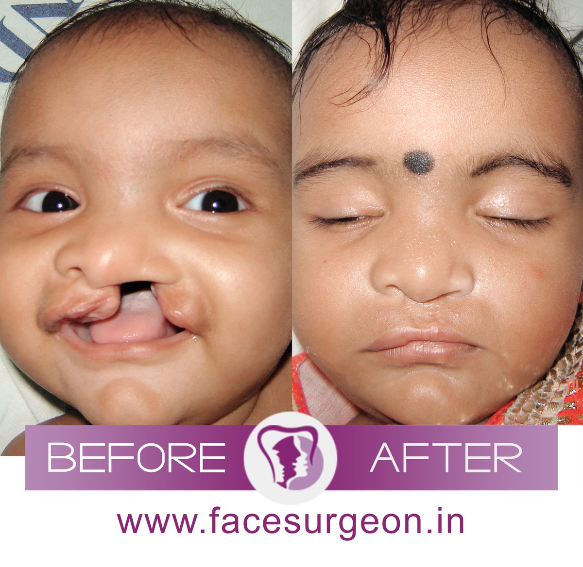 AndeiSoI's tweet photo. One #smile at a time is our #Mission 

#cleftsmile #cleftrepair #drsunilrichardson #clestsurgeon https://t.co/IXrggo3x5j