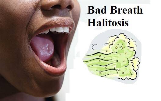 HALITOSIS, commonly known as bad breath, can contribute to a decreased self esteem or significant psychological distress. It is one of the common reasons as well, as to why people consult with oral health practitioners. [A THREAD]: