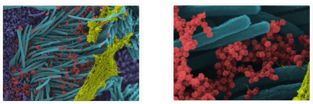 John Pace (@pacejohn) on Twitter photo Dr. Camille Ehre (<a href="/camilleehre/">Camille Ehre</a>) @ Marsico Lung Inst in NC has released some amazing pics of the SARS-Cov-2 virus (coronavirus) infecting lung cells. Fascinating! Original (uncolored) imgs published in New England Journal of Med nejm.org/doi/full/10.10… <a href="/MarkIIISystems/">Mark III Systems</a> #SARSCoV2 Dr. Camille Ehre (<a href="/camilleehre/">Camille Ehre</a>) @ Marsico Lung Inst in NC has released some amazing pics of the SARS-Cov-2 virus (coronavirus) infecting lung cells. Fascinating! Original (uncolored) imgs published in New England Journal of Med nejm.org/doi/full/10.10… <a href="/MarkIIISystems/">Mark III Systems</a> #SARSCoV2