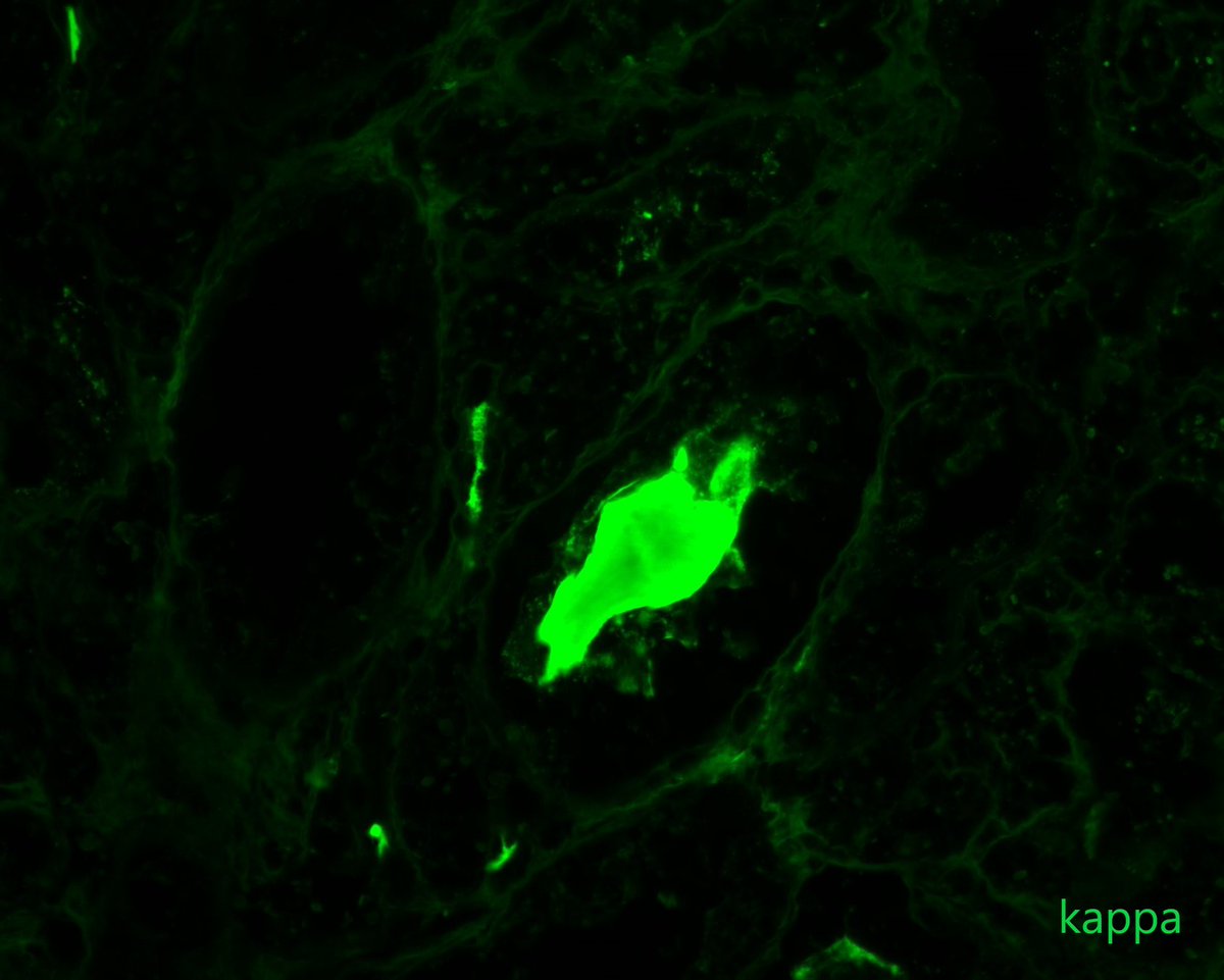 ClarissaCassol's tweet photo. At least, a few casts decided to collaborate and show some restriction! #MGRS #castnephropathy https://t.co/QELU6RK9sR