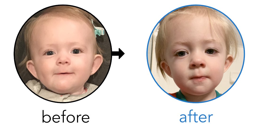 EarBuddies's tweet photo. Ashley from Colorado ๐บ๐ธ permanently corrected her baby Daughter's Ears with #EarBuddies - Find her story here: https://t.co/t8qE0ujBN7 #parenting #earbuddiesusa #ears #babyear #earcondition #motherhood #parenting #otoplasty #orejasdesoplillo #stickoutear #stickoutears #midwife https://t.co/KJ5Znzy8vw