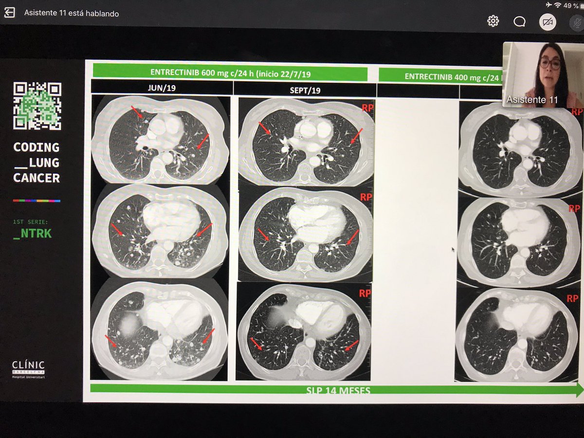 Teresa_Gorria's tweet image. Interesante webinar sobre NTRK👌🏽🤓 #keepLearning  #codinglungcancer @NReguart @teixido_c @Rm_Reyesc @hospitalclinic