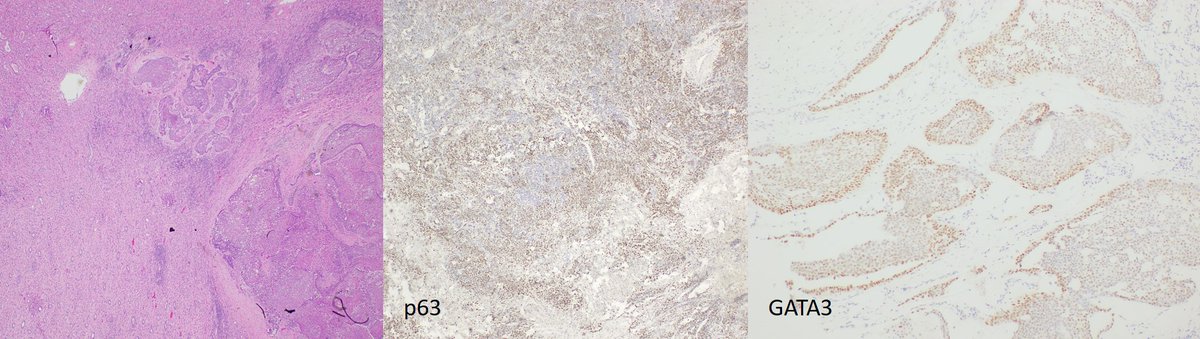 Just presented this cool case for a medicine CPC: 37yo male with a 12-cm renal pelvis mass and a 5-cm retro-peritoneal mass...

Poorly differentiated SCC, likely urothelial origin, with metastases! @Anjamkj  #PathTwitter