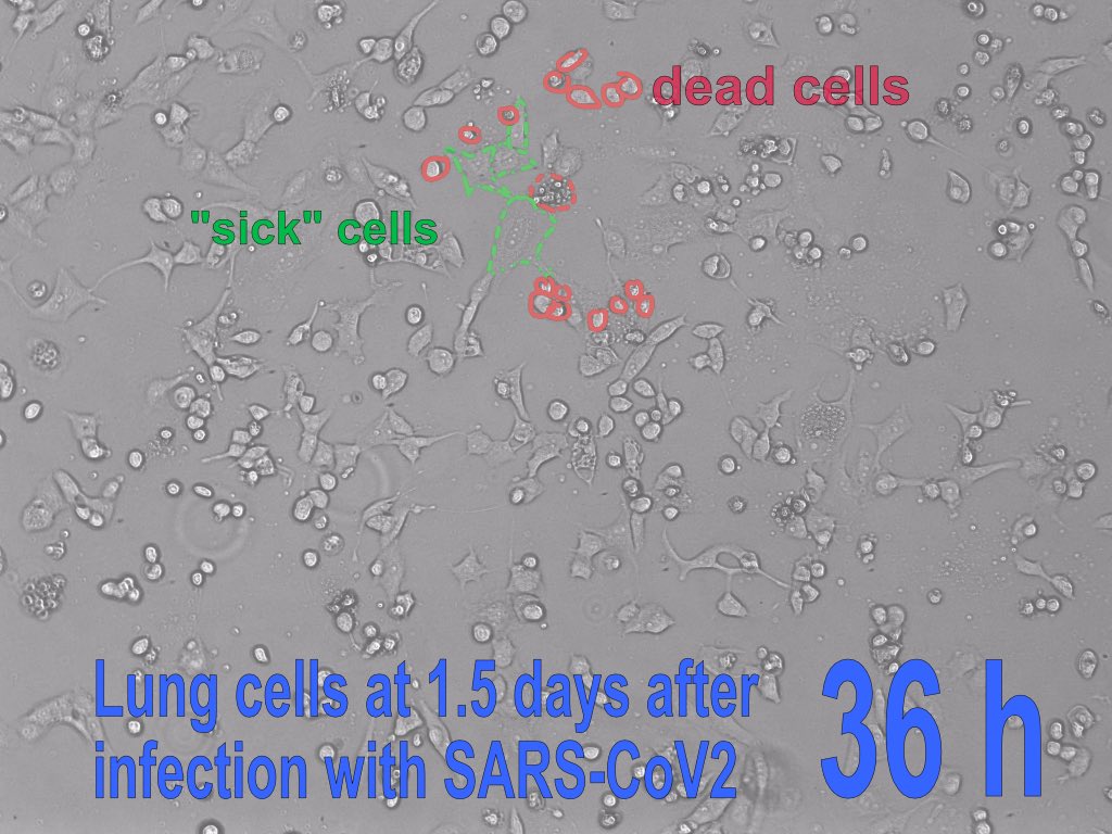 8/ The pictures show lung cells (A549-ACE2) infected with SARS-CoV2, such that roughly every 10th cell was infected (first two pictures): after 1.5 days most cells are dead! If you use 10 times more virus, about half a day is already enough!
