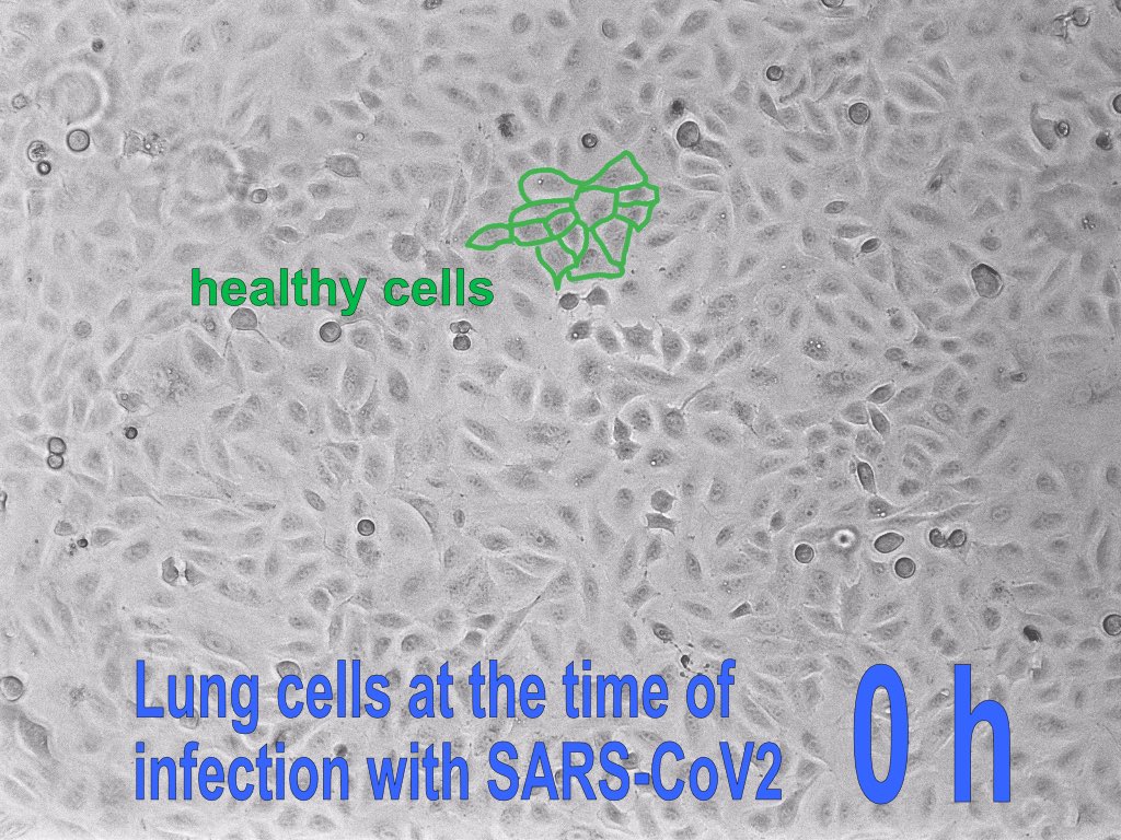 8/ The pictures show lung cells (A549-ACE2) infected with SARS-CoV2, such that roughly every 10th cell was infected (first two pictures): after 1.5 days most cells are dead! If you use 10 times more virus, about half a day is already enough!