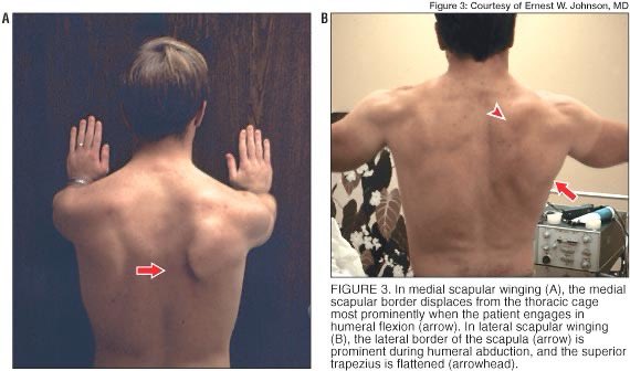 When it can’t do it’s job (usually other factors at play here too), the scapula will be “lost” on the ribcage and won’t have adequate congruency on it.We see this all the time with “winged out” scapulas.