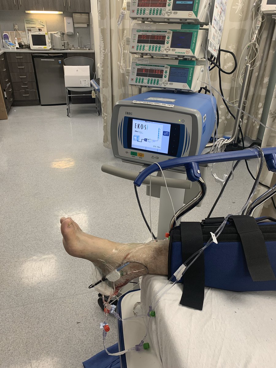 pankajkhullarmd's tweet photo. No femoral access? No problem. Patient had an EVAR placed in an outside institution and presented with worsening acute on chronic limb ischemia #pedalfirst EKOS followed early relook and adjunct thombectomy @sorinmedical @pgreen_md @Naviyd @CLIFightersBot https://t.co/TiNhNeMD0G