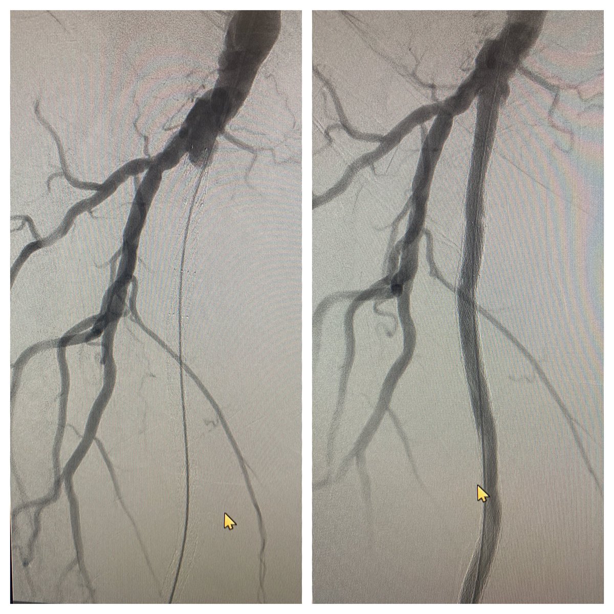 pankajkhullarmd's tweet photo. No femoral access? No problem. Patient had an EVAR placed in an outside institution and presented with worsening acute on chronic limb ischemia #pedalfirst EKOS followed early relook and adjunct thombectomy @sorinmedical @pgreen_md @Naviyd @CLIFightersBot https://t.co/TiNhNeMD0G
