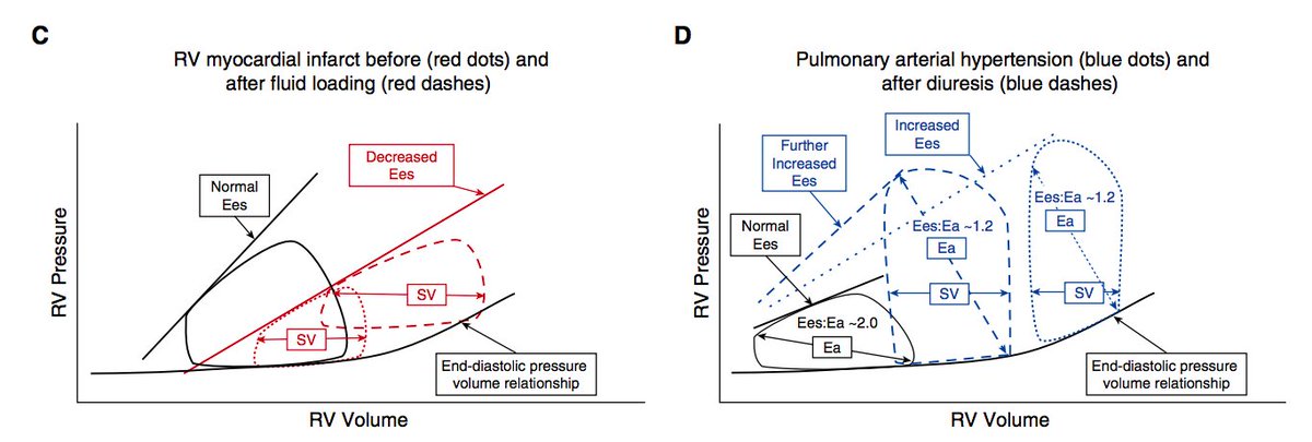 ArgaizR's tweet image. This makes some sense if low RV systolic function. My experience in non critically ill patients with pulmonary hypertension and RV disfunction is that portal vein is more helpful to guide diuresis.  Trying to decongest until non-plethoric IVC can result in orthostatic hypotension