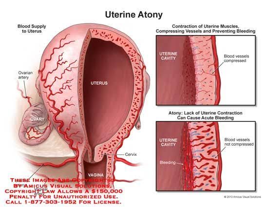 womb doesn't contract after delivery it's called "Uterine Atony" and it's the no. 1 cause of PPH- Causes Of Uterine Atony1. Multiple pregnancies 2. Overstretching of the womb from twins/triplets3. Prolonged labor4. Some drugs5. Full bladder, inability to urinate