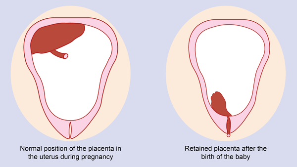 III. TISSUE (Retained Placenta)- Usually the placenta separates from the wall of the womb during labor and comes out after child birth but there are cases where the placenta remains in the womb after child birth- Retained placenta prevents uterine contraction which causes
