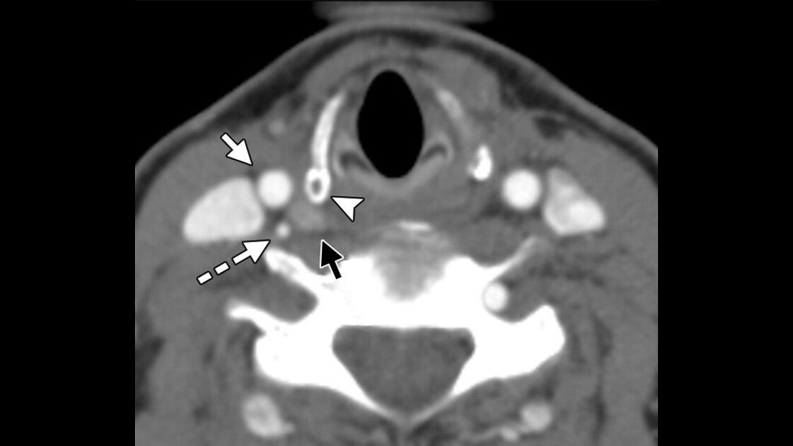 September is #ThyroidCancerAwarenessMonth. Thyroid cancer is the most common endocrine cancer, typically affecting more women than men. Read about the efficacy and safety of radiofrequency ablation for treatment of locally recurrent thyroid cancers: bit.ly/2me0RSq #IRad