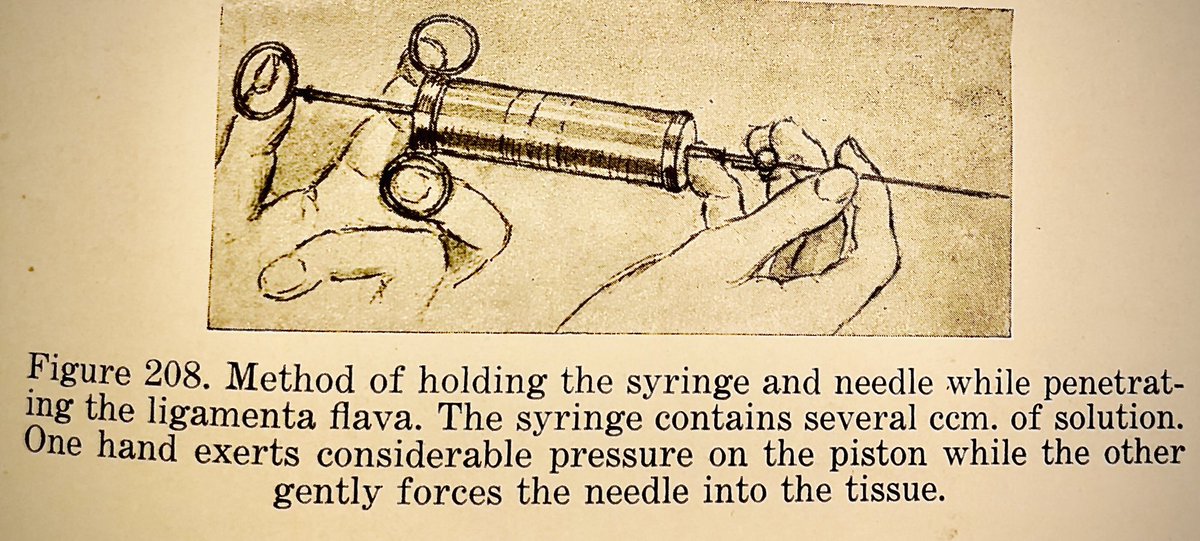 The first English language description of thoracic epidural anesthesia was presented by Achille Dogliotti in his 1939 textbook 'ANESTHESIA'. I doubt that anyone who has studied his chapter on Extradural Spinal Anesthesia (pg 521-566) has any difficulty placing epidurals.