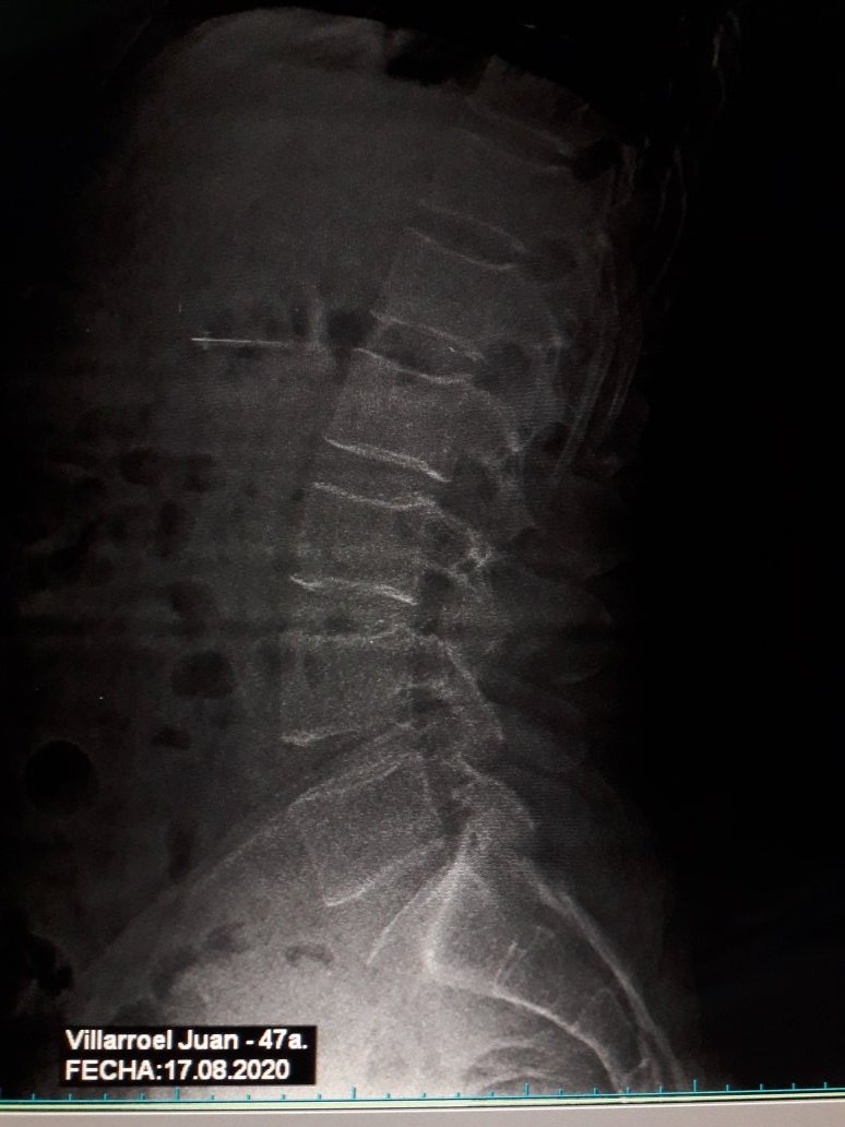 juravia's tweet photo. Dm @Ecastillo1226   dr esta es la placa q  me realice. Porque tenia dolor en la cintura  q parecia como lumbago. Puede ud revisarla? https://t.co/gOA6EFKOBP