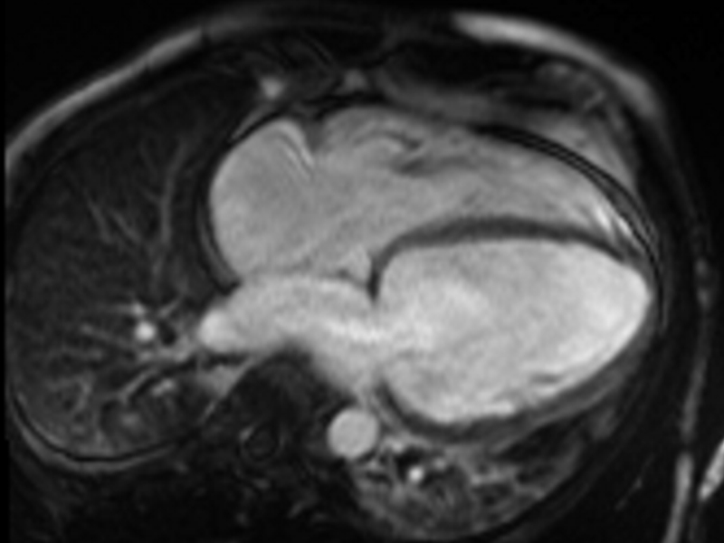 The inflammatory stress of COVID-19 presumably triggers some of these acute presentations, while others may incidentally occur or be detected during the COVID-19 illness.Here are the LGE images for the cases above: