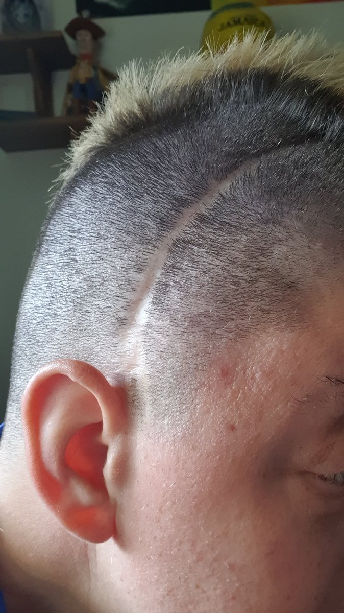 nottheperfectfit в Twitter: „A fresh hair cut, which means that my scar is on show. Which can lead to some questions. Often people think that it is part of my hair cut. nottheperfectfit в Twitter: „A fresh hair cut, which means that my scar is on show. Which can lead to some questions. Often people think that it is part of my hair cut.