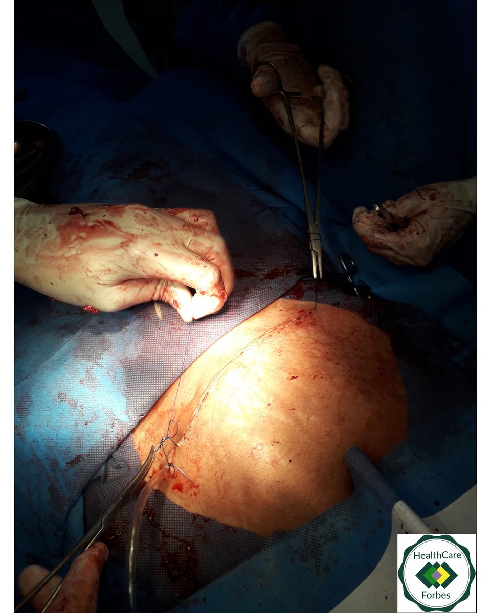 health_forbes's tweet photo. For complete article click the link 
https://t.co/287OSMSpSr

#csection #csectionrecovery #csectionrecovery #csectionmama #csectionbirth #csectionbelly #csectionbaby #csectionmoms #csectionstrong #motherhood #motherlove #operatoryroom #surgery #gynocologist #pharamercy #Health https://t.co/VVzl6V2YSF