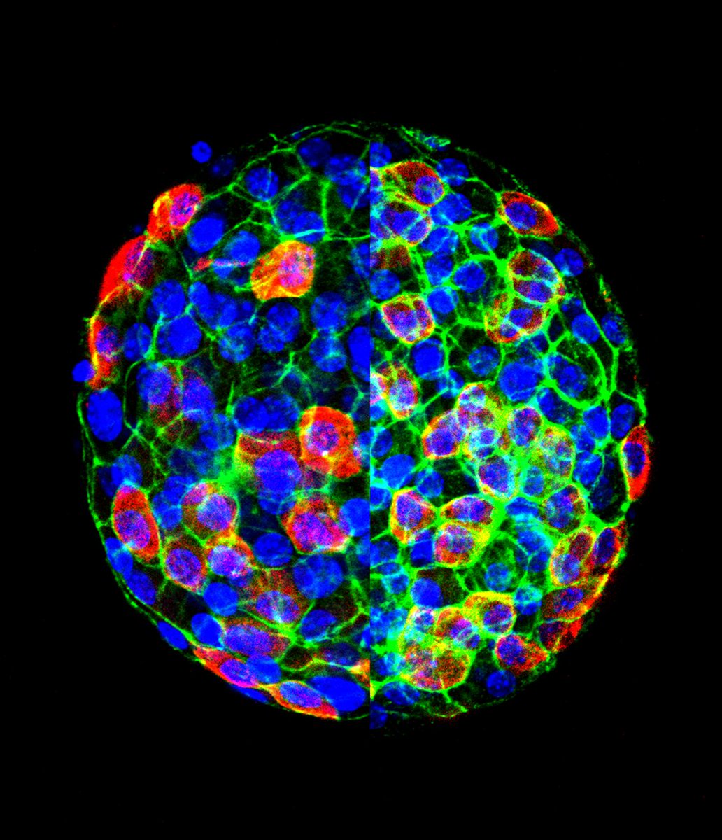 Centre Of Membrane Proteins and REceptors (@compare_uobuon) on Twitter photo The Islet biology lab <a href="/daveyboyhod/">David Hodson</a> studies how vitamin D binding protein (DBP) influences alpha cell function. High resolution imaging reveals changes in the actin cytoskeleton of islets wild type (left half) or deleted (right half) for DBP. Photo by <a href="/kitkat_time/">Katrina Viloria</a>. The Islet biology lab <a href="/daveyboyhod/">David Hodson</a> studies how vitamin D binding protein (DBP) influences alpha cell function. High resolution imaging reveals changes in the actin cytoskeleton of islets wild type (left half) or deleted (right half) for DBP. Photo by <a href="/kitkat_time/">Katrina Viloria</a>.
