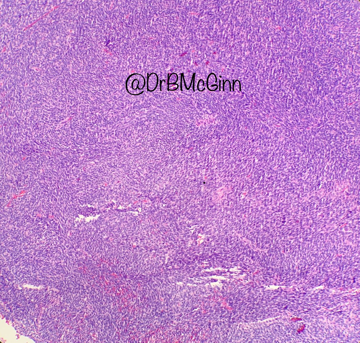 DrBMcGinn's tweet photo. Tweeples - A case of metastatic synovial sarcoma to the lung #pathology #lungpath https://t.co/uX2ghFWCAg
