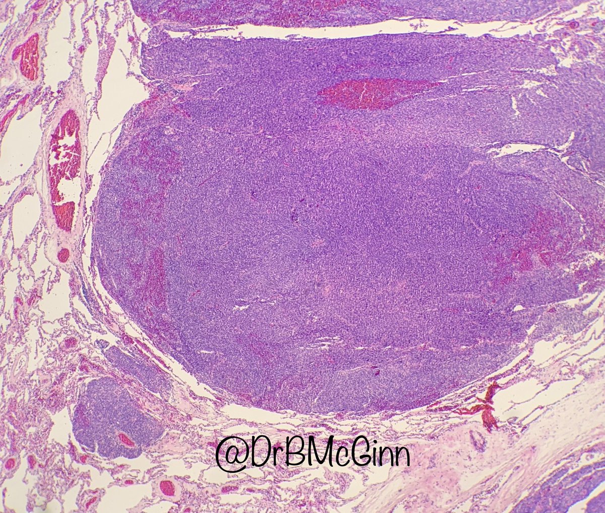 DrBMcGinn's tweet photo. Tweeples - A case of metastatic synovial sarcoma to the lung #pathology #lungpath https://t.co/uX2ghFWCAg