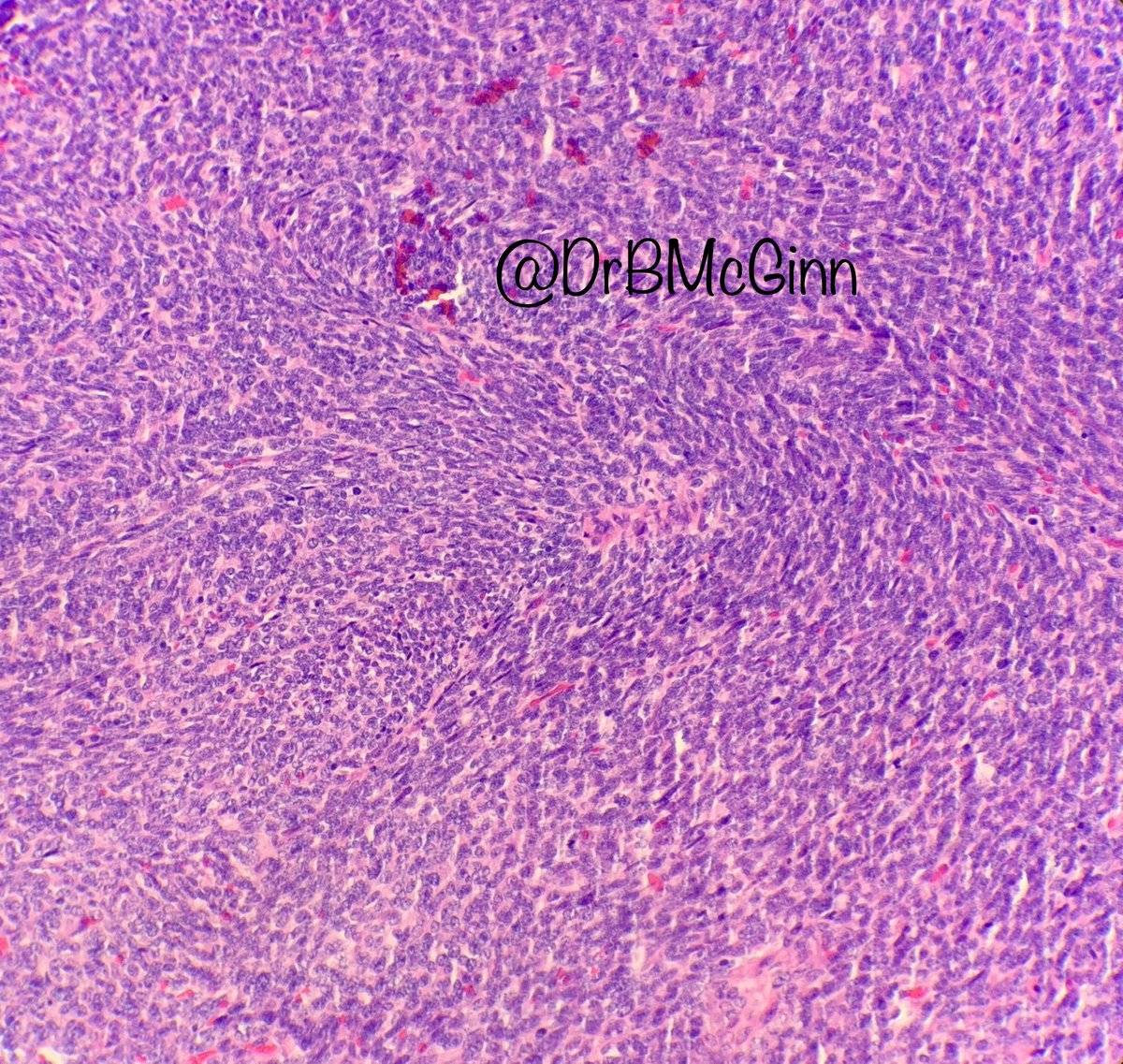 Tweeples - A case of metastatic synovial sarcoma to the lung #pathology #lungpath