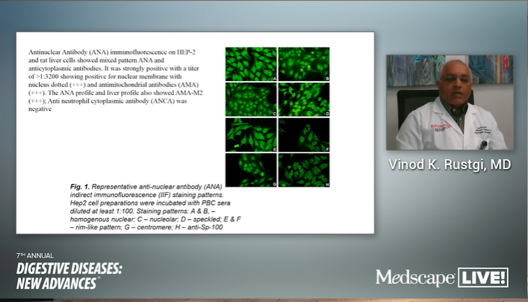 ddnacme's tweet photo. Vinod K. Rustgi, MD, MBA presents Autoimmune Hepatitis and Overlap Syndromes #hepatitis #DDNA2020 https://t.co/YSZW4SHYxY