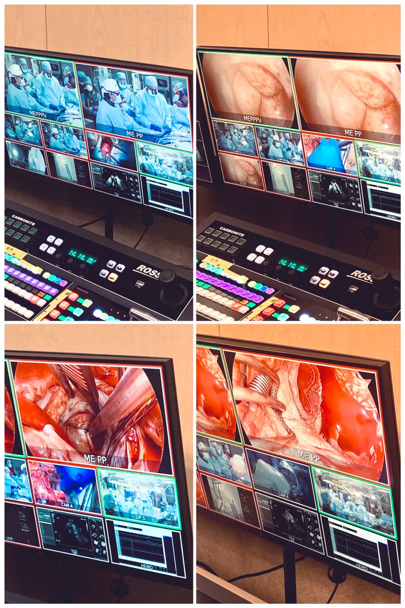 Marcus R. Burns (@mryburns) on Twitter photo Busy day filming for #TCTConnect #tct2020 Innovative, elegantly performed hybrid #ViV #TMVR — Very honored to be a part of this team — complimentary skills committed to a common purpose <a href="/bapat_savrtavr/">vinayak bapat</a> <a href="/PSorajja/">Paul</a> <a href="/JoaoLCavalcante/">João Cavalcante</a> <a href="/MHIF_Heart/">Minneapolis Heart Institute Foundation</a> Busy day filming for #TCTConnect #tct2020 Innovative, elegantly performed hybrid #ViV #TMVR — Very honored to be a part of this team — complimentary skills committed to a common purpose <a href="/bapat_savrtavr/">vinayak bapat</a> <a href="/PSorajja/">Paul</a> <a href="/JoaoLCavalcante/">João Cavalcante</a> <a href="/MHIF_Heart/">Minneapolis Heart Institute Foundation</a>