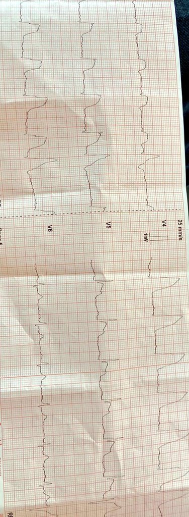 OnlyECG (@onlyecg1) on Twitter photo 55 yo with CP
Shark fin morphology?
@ecg_master <a href="/EM_RESUS/">Sam Ghali, M.D.</a> <a href="/ECGfan/">Laszlo Farkas</a> <a href="/ecgrhythms/">Arnel Carmona</a> <a href="/smithECGBlog/">Stephen W. Smith</a> <a href="/ShariqShamimMD/">Dr Shariq Shamim</a> <a href="/anunay_cardio/">Anunay Gupta MD, DM</a> 55 yo with CP
Shark fin morphology?
@ecg_master <a href="/EM_RESUS/">Sam Ghali, M.D.</a> <a href="/ECGfan/">Laszlo Farkas</a> <a href="/ecgrhythms/">Arnel Carmona</a> <a href="/smithECGBlog/">Stephen W. Smith</a> <a href="/ShariqShamimMD/">Dr Shariq Shamim</a> <a href="/anunay_cardio/">Anunay Gupta MD, DM</a>
