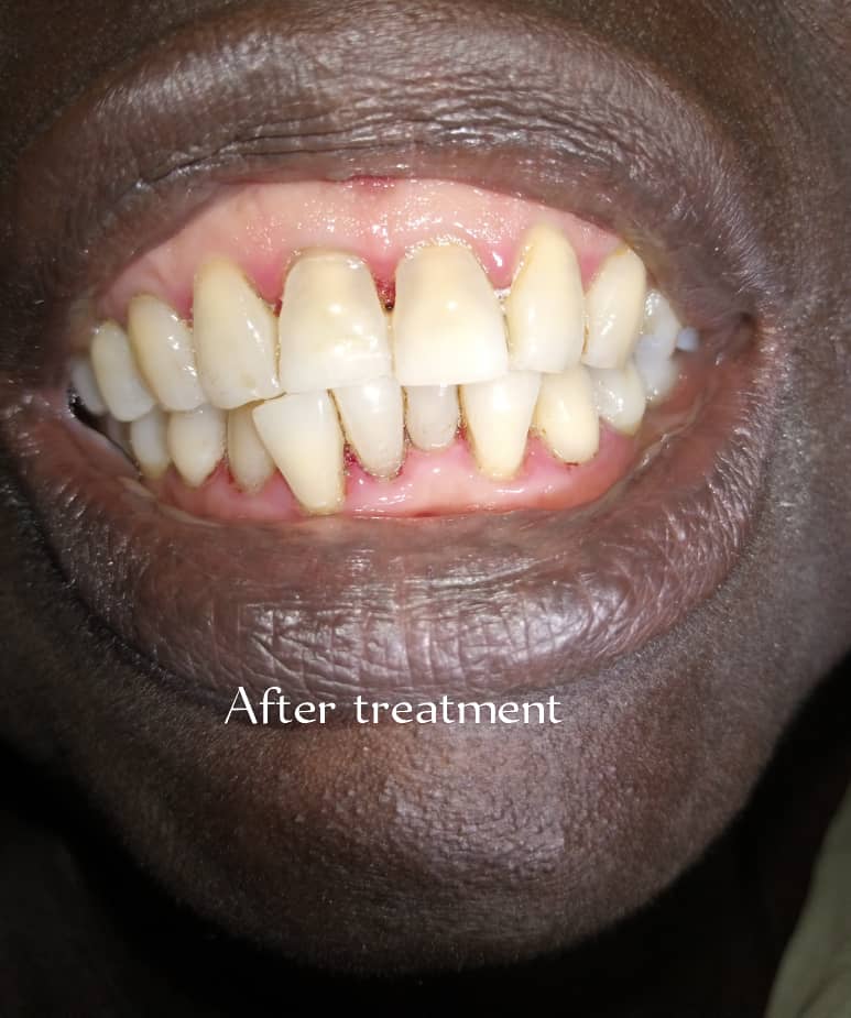 A 63 year old woman who could not smile in the public due to a poor state of oral health. She had both her smile and sound oral health restored at the Dental Centre, ABUAD Multi-System Hospital, Ado-Ekiti. #dentistry #dentalcare