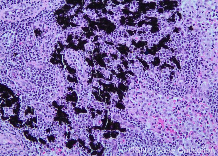 PGSharmaMD's tweet photo. Great job to everyone who tried the #RSNACC Case-of-the-Week: Intranodal Tattoo Pigment!!  https://t.co/iYOyiAi42x 

Thanks @RSNA #BreastImaging Deputy Editor Dr Bennett @MIRimaging and authors Peterson, @AripoliAllison and @Maura_ONeilJ @KURadiology @BreastRadiology @SBIRFS https://t.co/ejr73Q9av2