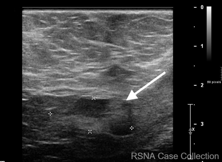 PGSharmaMD's tweet photo. Great job to everyone who tried the #RSNACC Case-of-the-Week: Intranodal Tattoo Pigment!!  https://t.co/iYOyiAi42x 

Thanks @RSNA #BreastImaging Deputy Editor Dr Bennett @MIRimaging and authors Peterson, @AripoliAllison and @Maura_ONeilJ @KURadiology @BreastRadiology @SBIRFS https://t.co/ejr73Q9av2