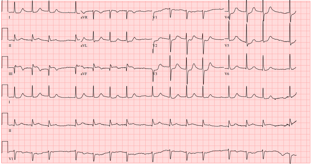 BID_CMRs's tweet photo. Residents and students! Challenge yourself with this #chestpain case!
88M p/w 2d of #dyspnea and #chestpain
First, what would you expect to see on his #coronary angiography
Second, we also have a question on his #TEE below
#mediaoftheweek submitted by Ishan Tatake https://t.co/mGAQ30ujAo