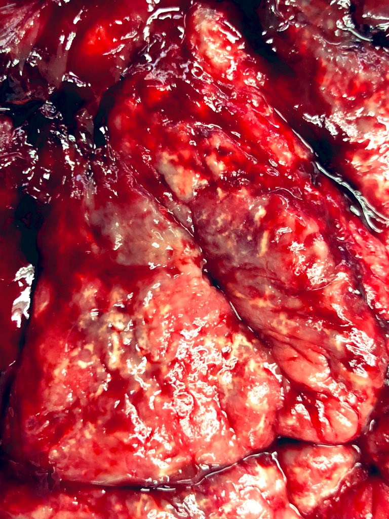 Definitely not my specialty, so... what changes can be seen in this #placenta #perinatalpath #stillborn