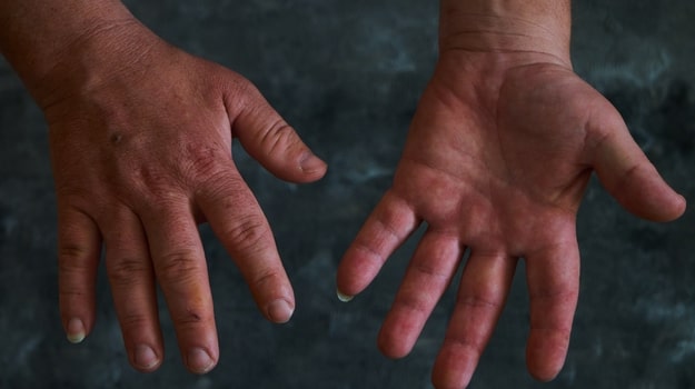 BioCalifornia's tweet image. Chiasma’s Octreotide Capsules Could Be Answer to Acromegaly Treatment Burdens bit.ly/3iE8pq1