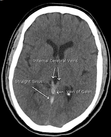 JAcharya4's tweet photo. Non contrast and CTV images in a 30's y/o patient with #COVID19 transferred from OSH for "SDH" 

Note the high density in the venous structures on non con with corresponding lack of opacification on CTV. 

Dx: Deep CVT in Covid19. See link from @TheAJNR  

https://t.co/1jPvo53oeO https://t.co/I3Hlof5Wh9