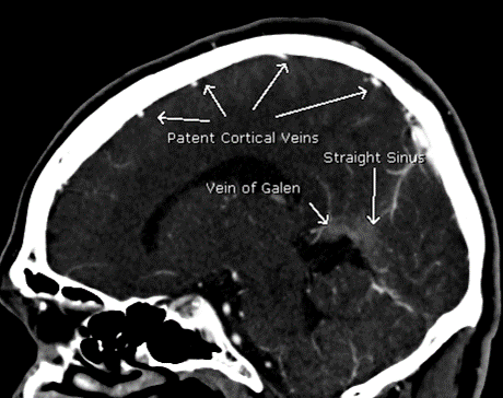 Non contrast and CTV images in a 30's y/o patient with #COVID19 transferred from OSH for "SDH" 

Note the high density in the venous structures on non con with corresponding lack of opacification on CTV. 

Dx: Deep CVT in Covid19. See link from <a href="/TheAJNR/">AJNR</a>  

ajnr.org/content/early/…