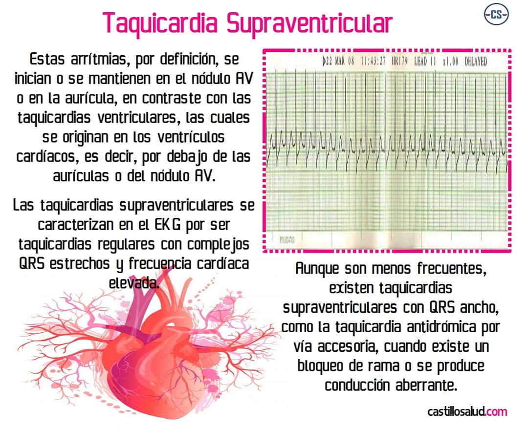 castillosalud1's tweet photo. Taquicardia Supraventricular

#18DeSeptiembre #18Sept #medstudents #MedStudentTwitter #cardiotwitter #medschool https://t.co/VAisnvWIKe