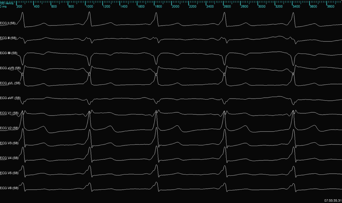subparsonsmaps's tweet image. Utilized #HDGrid to quickly make an open window map of this AP in a WPW patient. Preexcitation was lost on the first burn after 2 seconds of RF. #mapmoreburnless #EPeeps @AbbottCardio