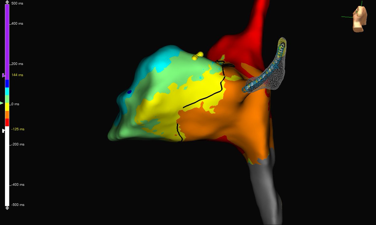 subparsonsmaps's tweet image. Utilized #HDGrid to quickly make an open window map of this AP in a WPW patient. Preexcitation was lost on the first burn after 2 seconds of RF. #mapmoreburnless #EPeeps @AbbottCardio