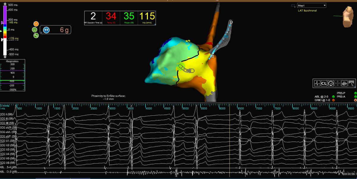 subparsonsmaps's tweet image. Utilized #HDGrid to quickly make an open window map of this AP in a WPW patient. Preexcitation was lost on the first burn after 2 seconds of RF. #mapmoreburnless #EPeeps @AbbottCardio